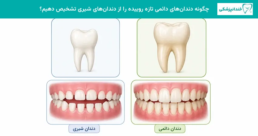 چگونه دندانهای دائمی تازه روییده را از دندانهای شیری تشخیص دهیم؟
