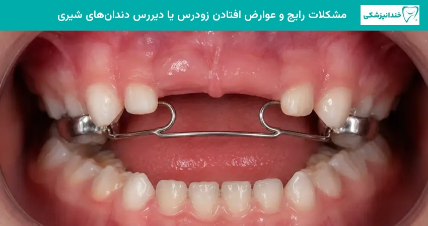 مشکلات رایج و عوارض افتادن زودرس یا دیررس دندانهای شیری