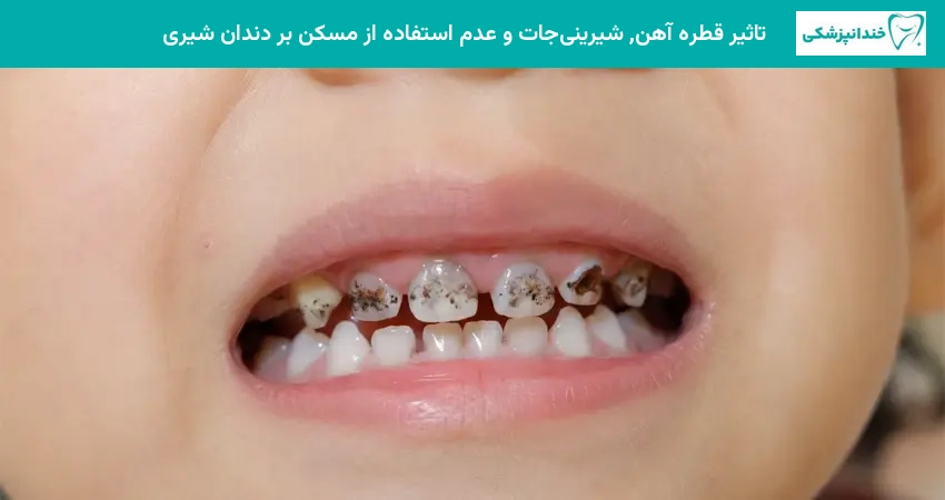 تاثیر قطره آهن, شیرینیجات و عدم استفاده از مسکن بر دندان شیری