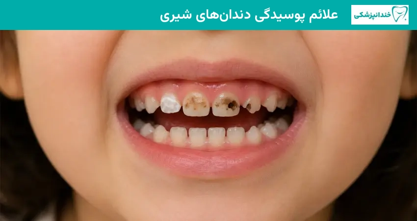 علائم پوسیدگی دندانهای شیری