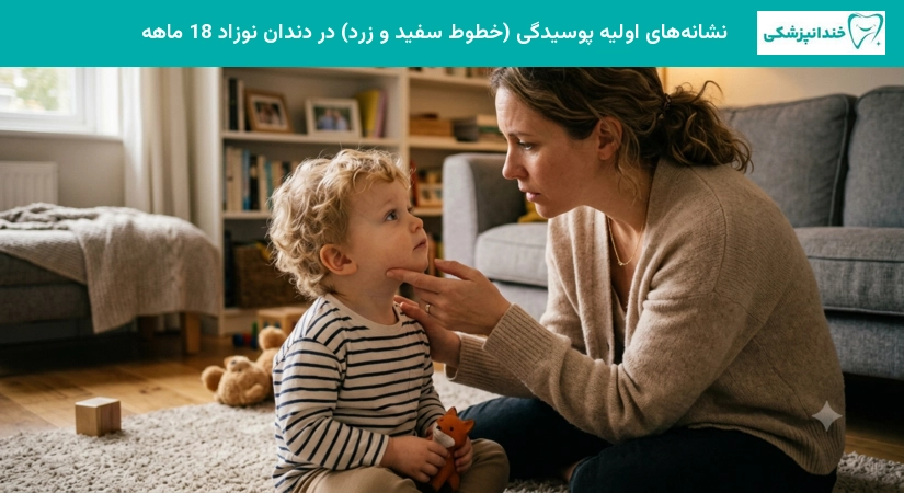 نشانه های اولیه پوسیدگی (خطوط سفید و زرد) در دندان نوزاد نوزاد 18 ماهه
