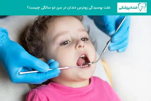 علت پوسیدگی زودرس دندان در سن دو سالگی چیست؟