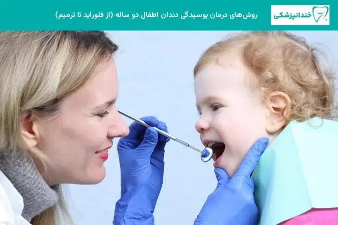 روشهای درمان پوسیدگی دندان اطفال دو ساله (از فلوراید تا ترمیم)