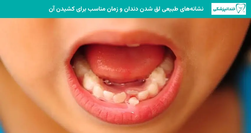 نشانههای طبیعی لق شدن دندان و زمان مناسب برای کشیدن آن