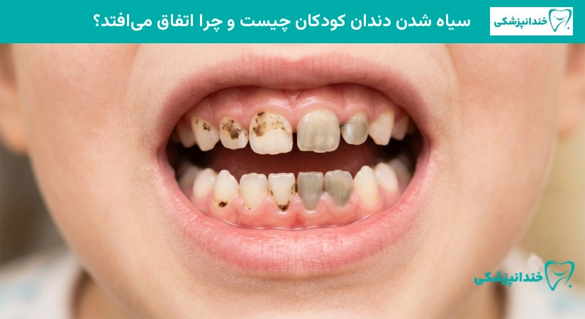 سیاه شدن دندان شیری کودک بر اثر پوسیدگی | خندانپزشکی