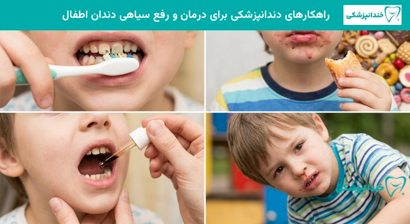 راهکار جلوگیری از سیاه شدن دندان های شیری کودکان