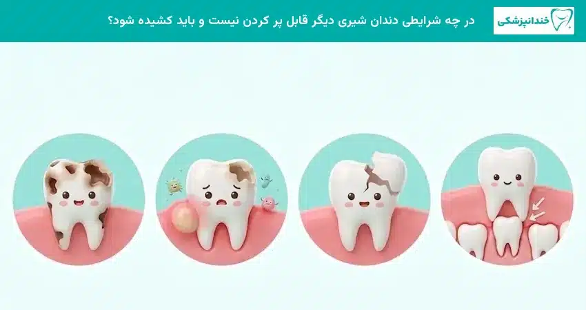 در چه شرایطی دندان شیری دیگر قابل پر کردن نیست و باید کشیده شود؟