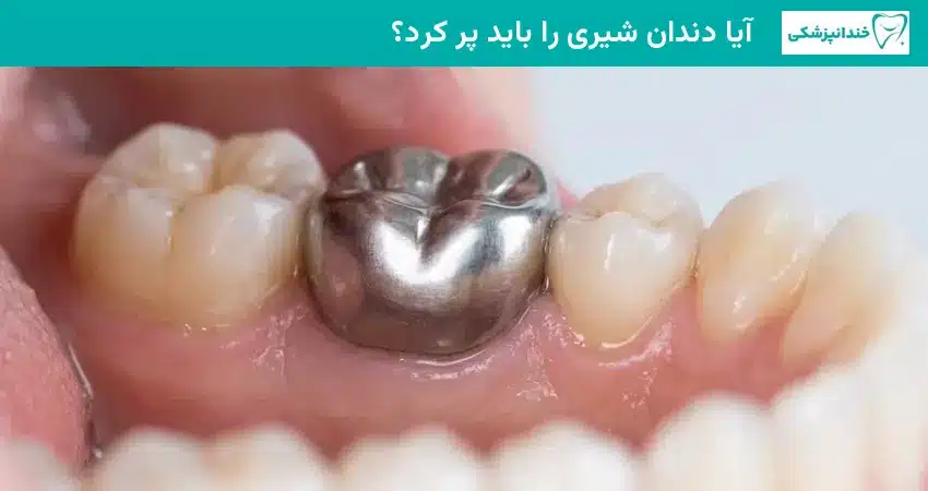 آیا دندان شیری را باید پر کرد؟