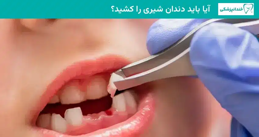 آیا باید دندان شیری را کشید؟