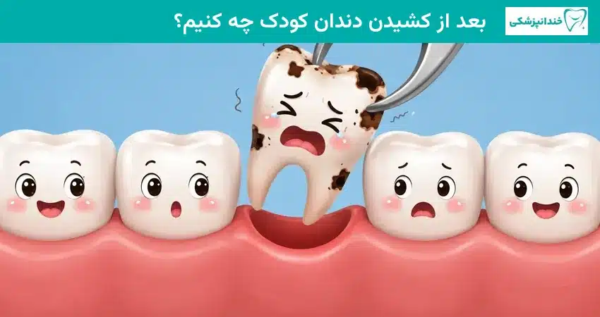 بعد از کشیدن دندان کودک چه کنیم؟