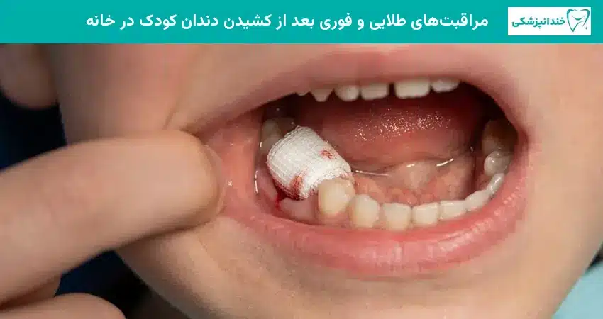 مراقبتهای طلایی و فوری بعد از کشیدن دندان کودک در خانه