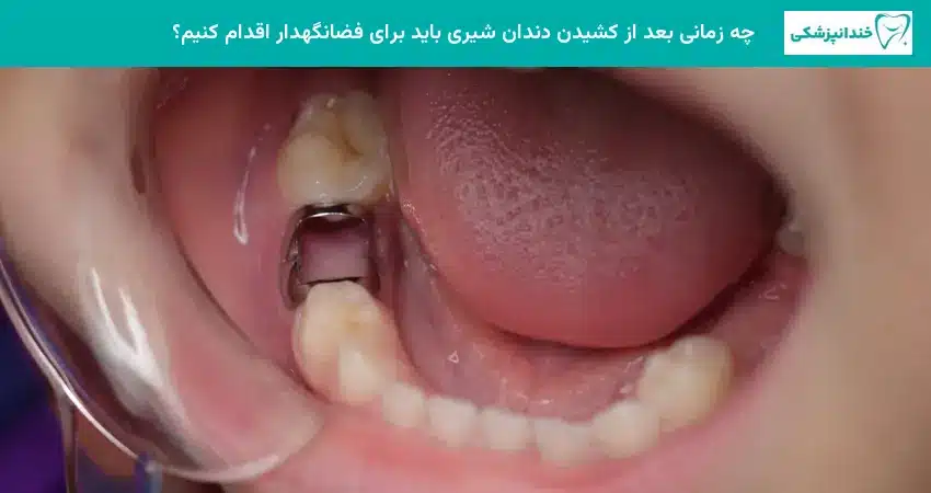 چه زمانی بعد از کشیدن دندان شیری باید برای فضانگهدار اقدام کنیم؟