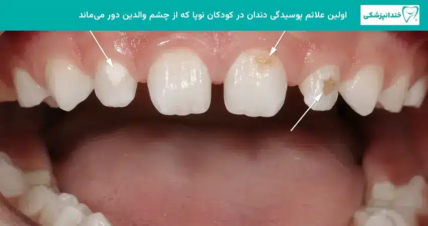 اولین علائم پوسیدگی دندان در کودکان نوپا که از چشم والدین دور میماند