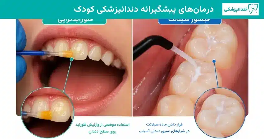 درمان های پیشگیرانه دندانپزشکی کودک