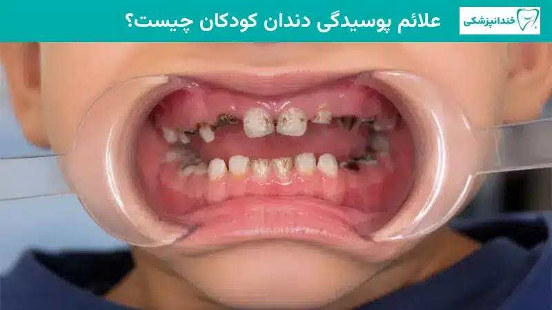 علائم پوسیدگی دندان کودکان چیست؟
