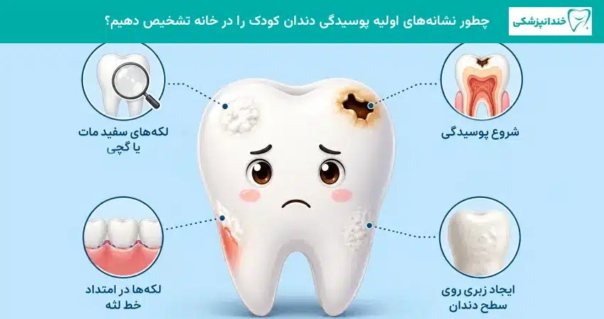 چطور نشانههای اولیه پوسیدگی دندان کودک را در خانه تشخیص دهیم؟