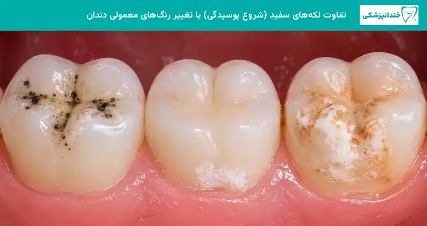 تفاوت لکههای سفید (شروع پوسیدگی) با تغییر رنگهای معمولی دندان