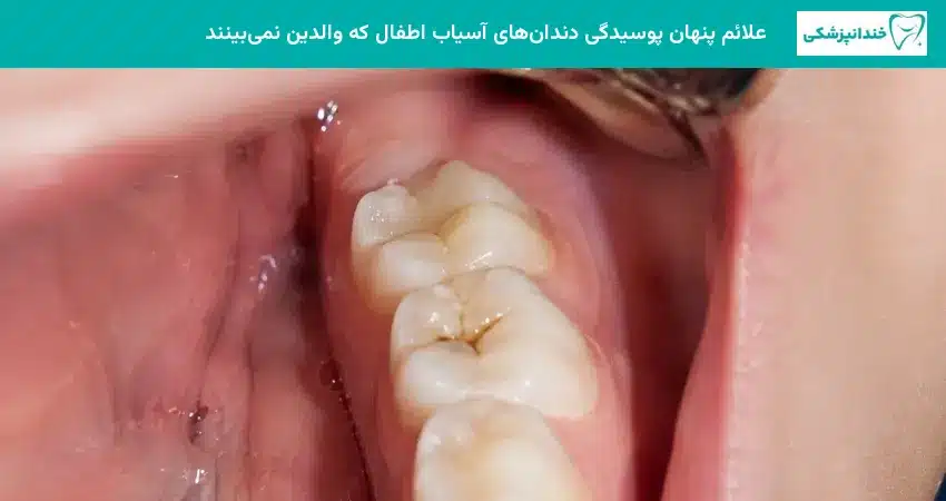 علائم پنهان پوسیدگی دندانهای آسیاب اطفال که والدین نمیبینند