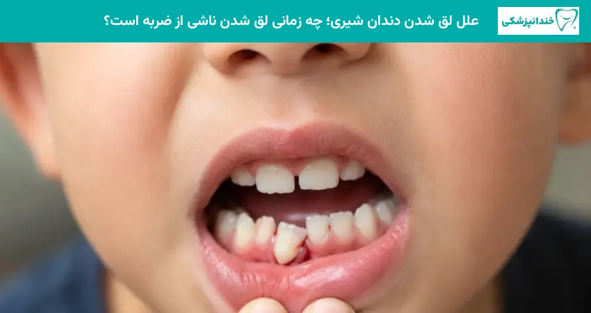 علل لق شدن دندان شیری؛ چه زمانی لق شدن ناشی از ضربه است؟
