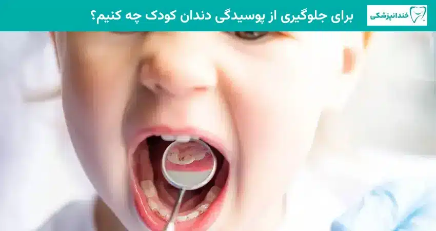 برای جلوگیری از پوسیدگی دندان کودک چه کنیم؟