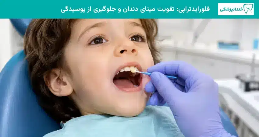 فلورایدتراپی: تقویت مینای دندان و جلوگیری از پوسیدگی