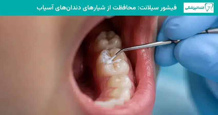 فیشور سیلانت: محافظت از شیارهای دندانهای آسیاب