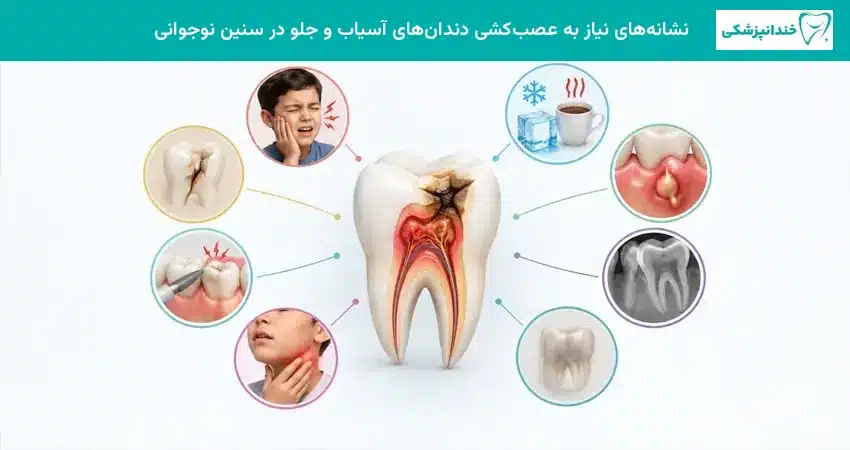 نشانه های نیاز به عصب کشی دندان های آسیاب و جلو در سنین نوجوانی