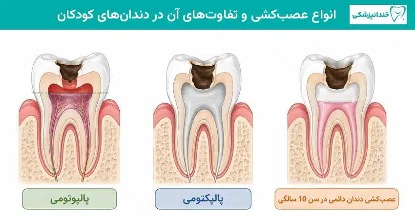 انواع عصب کشی و تفاوت های آن در دندان های کودکان