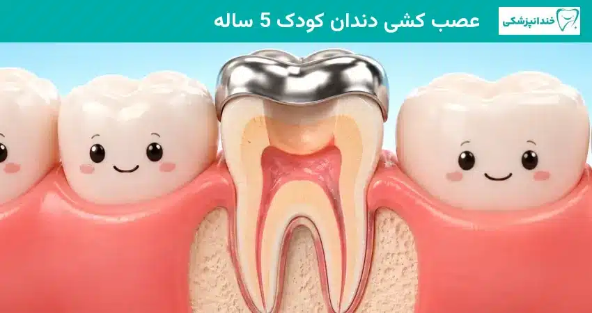 عصب کشی دندان کودک 5ساله