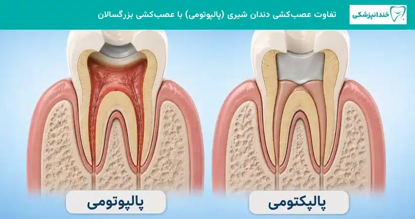 تفاوت عصب کشی دندان شیری پالپوتومی با عصب کشی بزرگسالان