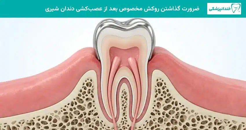 ضرورت گذاشتن روکش مخصوص بعد از عصبکشی دندان شیری