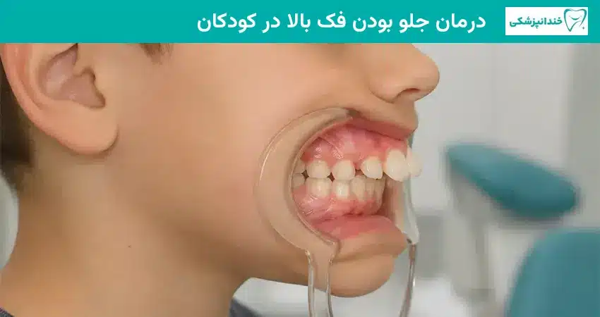 درمان جلو بودن فک بالا در کودکان