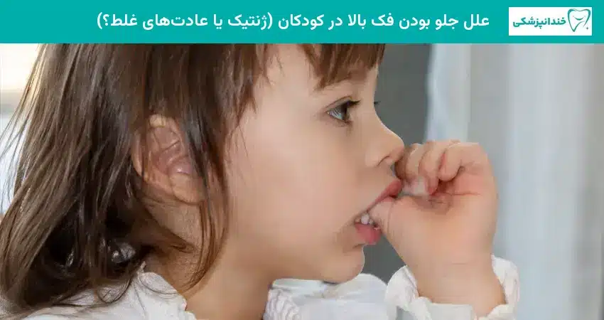 علل جلو بودن فک بالا در کودکان