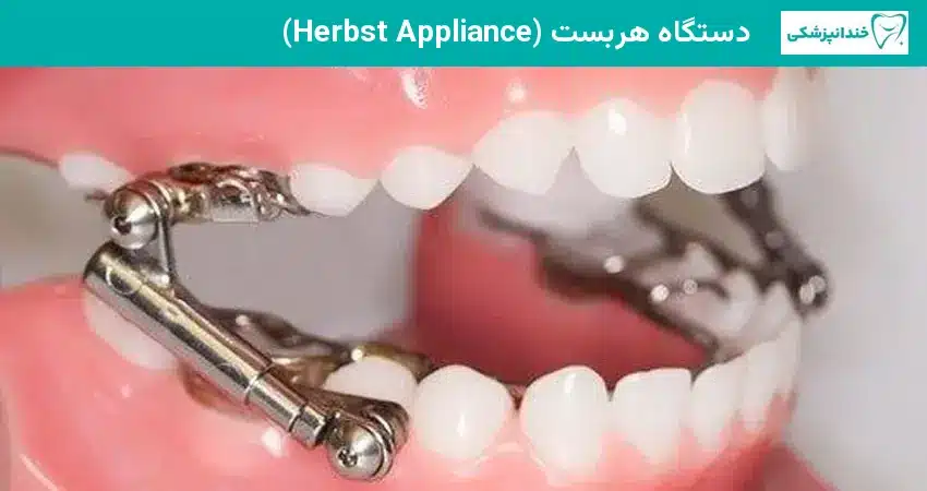 دستگاه هربست در درمان جلو آمدن فک کودکان