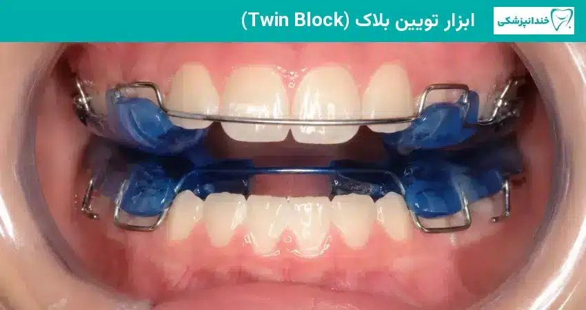ابزار تویین بلاک در درمان جلو آمدن فک کودکان