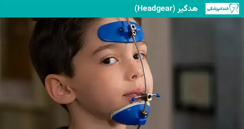 دستگاه هدگیر در درمان جلو آمدن فک کودکان
