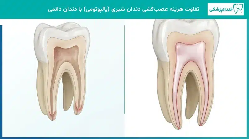 تفاوت هزینه عصب کشی دندان شیری با دندان دائمی