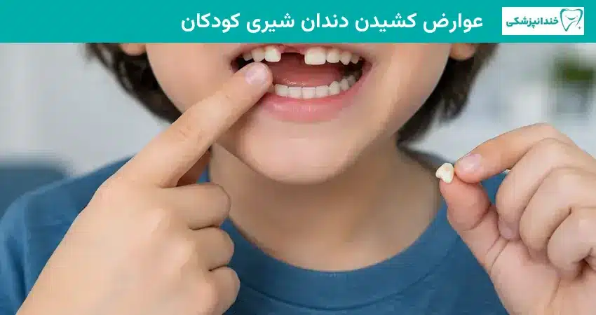 عوارض کشیدن دندان شیری کودکان