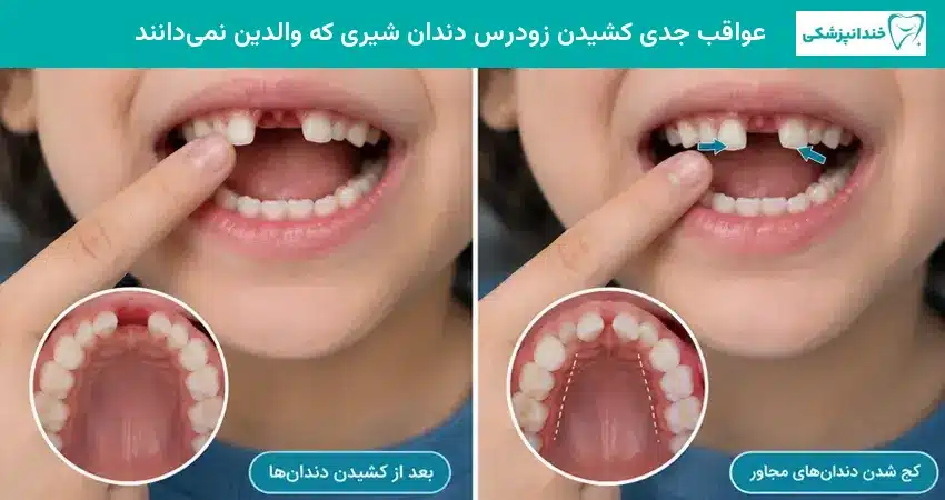عواقب جدی کشیدن زودرس دندان شیری که والدین نمی دانند