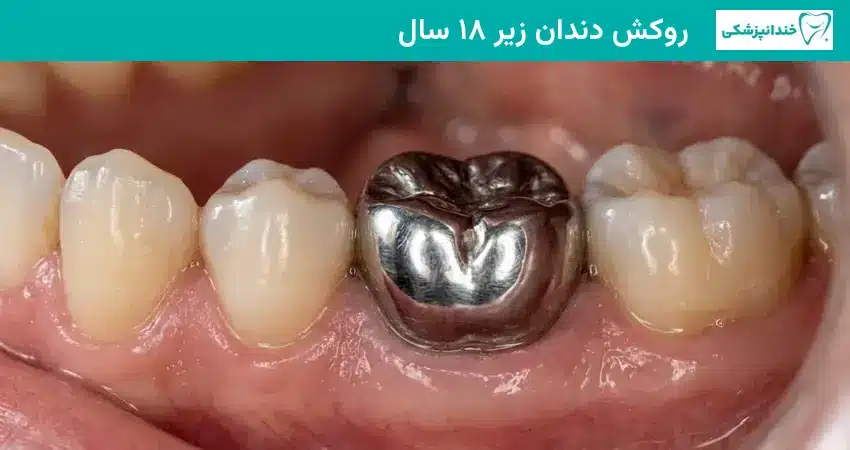 روکش دندان زیر ۱۸ سال