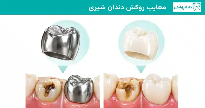 معایب روکش دندان شیری
