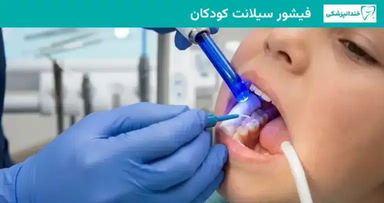 فیشور سیلانت کودکان