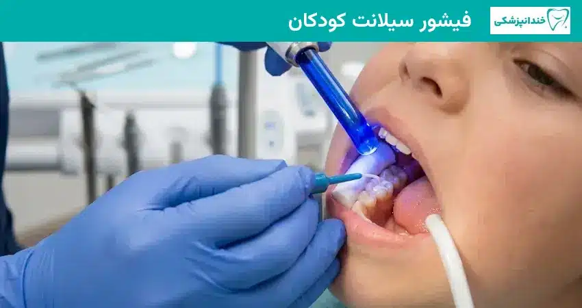 فیشور سیلانت کودکان