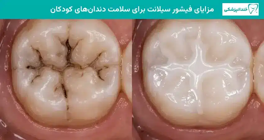 مزایای فیشور سیلانت برای سلامت دندانهای کودکان