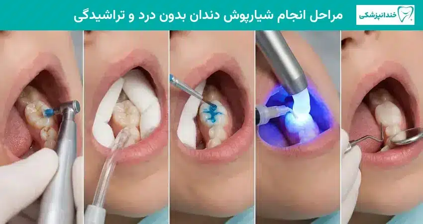 مراحل انجام شیارپوش دندان بدون درد و تراشیدگی