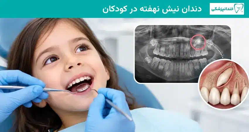 دندان نیش نهفته در کودکان