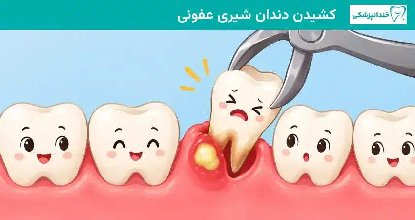 کشیدن دندان شیری عفونی