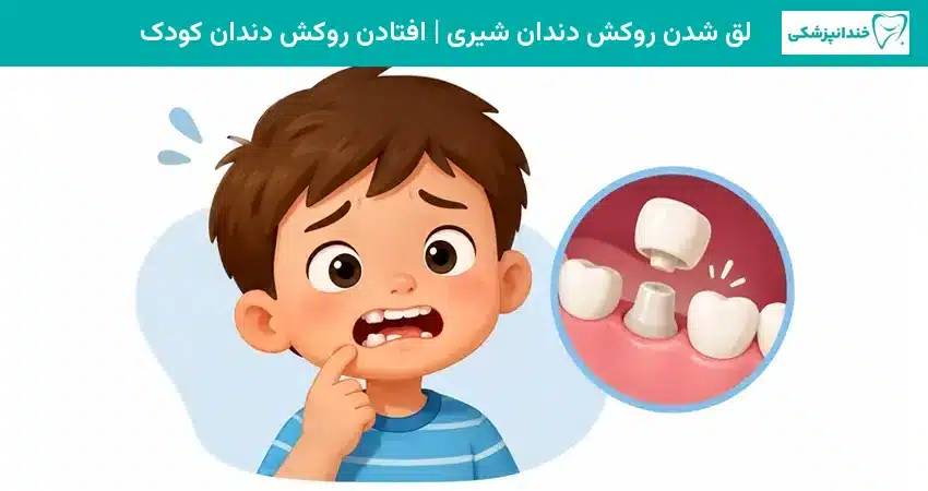 لق شدن روکش دندان شیری - افتادن روکش دندان کودک