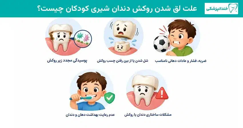علت لق شدن روکش دندان شیری کودکان چیست؟