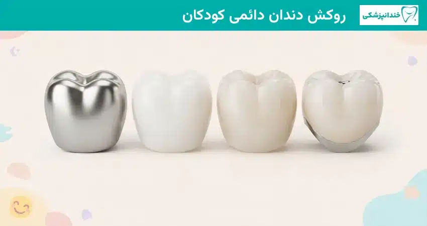 روکش دندان دائمی کودکان